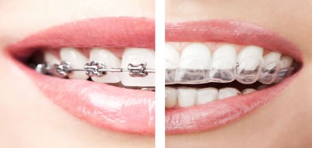 بين تقويم الأسنان التقليدي والشفاف
